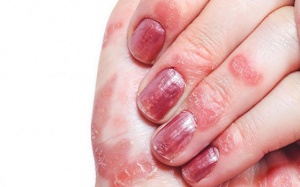 Hỗ trợ điều trị vảy nến móng tay bằng biện pháp tự nhiên