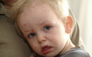 Đâu là dấu hiệu cảnh báo bệnh tay chân miệng trở nặng?