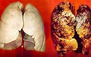 Người bị ung thư phổi giai đoạn cuối sống được bao lâu?