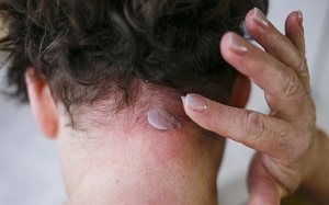 Vảy nến da đầu nên bôi thuốc gì cho hiệu quả nhanh?