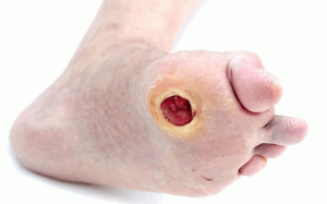 Cách chăm sóc bàn chân cho người bệnh đái tháo đường