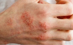Cách kiểm soát bệnh chàm đơn giản bằng các nguyên liệu tự nhiên