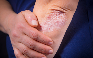 Làm thế nào để kiểm soát viêm khớp vảy nến?