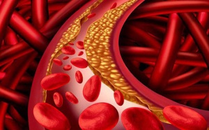 Những dấu hiệu cảnh báo máu nhiễm mỡ bạn không nên bỏ qua