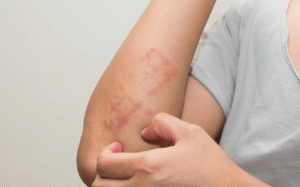 7 tình trạng da liễu phổ biến khiến da mẩn ngứa