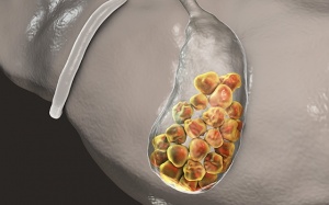 Sỏi túi mật 18mm không triệu chứng có nguy hiểm không, điều trị thế nào?