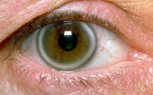 Dấu hiệu ở mắt giúp phát hiện tình trạng mỡ máu cao