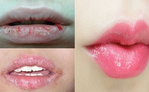 Mẹo xử lý đôi môi khô, nứt nẻ trong mùa Đông giá lạnh