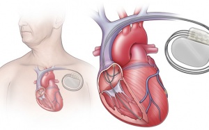 Liệu pháp tái đồng bộ tim - “cứu cánh” cho người rối loạn nhịp tim