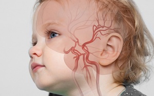 Bé 3 tuổi đột quỵ do túi phình mạch máu não