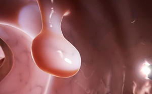 Người bị polyp túi mật nên ăn uống như thế nào?