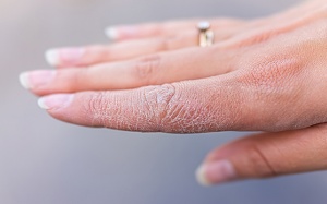 Chăm sóc da khô nẻ với dưỡng thể dạng dầu hay dạng sữa?