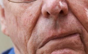 Người bị tai biến méo miệng phải làm gì để cải thiện?