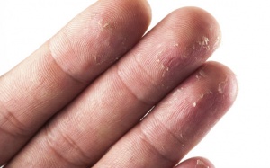 Bong tróc da đầu ngón tay làm mất vân tay là do đâu?