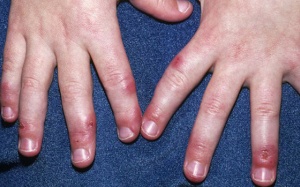 Cách trị cước chân tay trong mùa Đông 