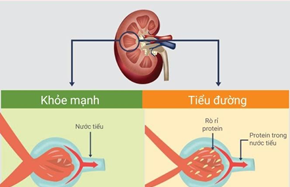 Vì sao biến chứng suy thận lại nguy hiểm với người tiểu đường?