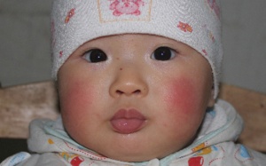 Trẻ bị nẻ má, mẹ phải làm thế nào?