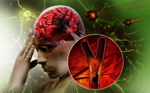 Đột quỵ nguy hiểm như thế nào?