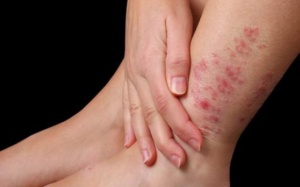 Khi bị viêm da cơ địa nên kiêng thực phẩm nào?