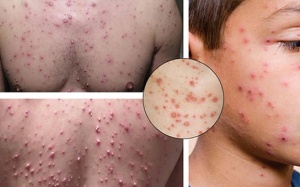 Bí quyết xóa tan sẹo thủy đậu bằng phương pháp tự nhiên