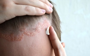 Ngăn ngừa vảy nến da đầu bằng cách nào?