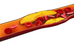 4 triệu chứng cảnh báo bệnh máu nhiễm mỡ