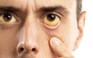 Những nguyên nhân thường gặp gây vàng da, ứ mật