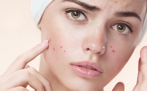 Trị mụn sau Tết, chị em cần lưu ý điều gì?
