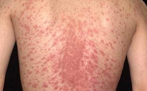 Bệnh vảy phấn hồng điều trị như thế nào?