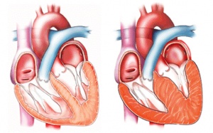 Dày thất trái là gì, có nguy hiểm hay không?