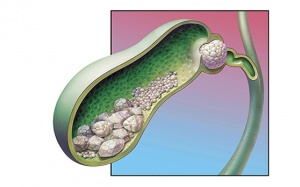 Nhiều sỏi túi mật, chưa đau dùng TPBVSK Kim Đởm Khang được không?
