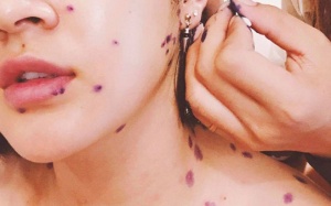 5 thực phẩm bạn cần tránh khi bị thủy đậu