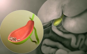 Sỏi túi mật 5mm nên điều trị thế nào?