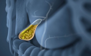 Nhiều viên sỏi mật tụ thành đám 8 - 10mm nên điều trị thế nào?