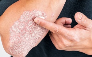 Những điều cần biết về bệnh vảy nến toàn thân