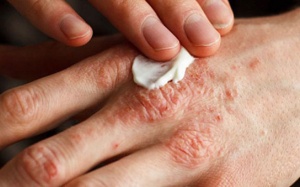  Giấm táo có giúp giảm các triệu chứng của bệnh chàm?