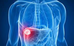 Ung thư biểu mô tế bào gan điều trị thế nào?