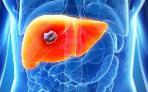 Sỏi gan 5mm dùng TPBVSK Kim Đởm Khang được không?