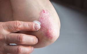 Điều trị vảy nến như thế nào cho hiệu quả?