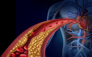 Chỉ số mỡ máu tăng cao gây ra những vấn đề sức khỏe gì?