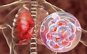 Chung tay chấm dứt bệnh lao với tinh thần như chống COVID-19