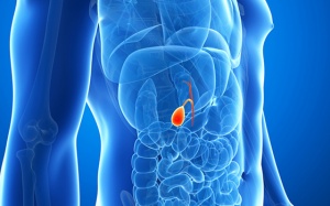 Sỏi mật 25mm dùng TPBVSK Kim Đởm Khang được không?