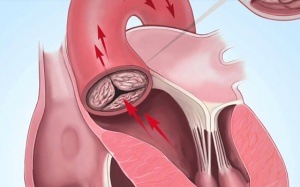 Vôi hóa van tim, thiếu máu tim điều trị thế nào?