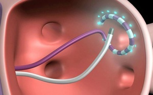 Tổng quan về phương pháp đốt điện tim trị rối loạn nhịp tim