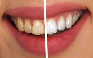 Răng ố vàng, xỉn màu phải làm sao?