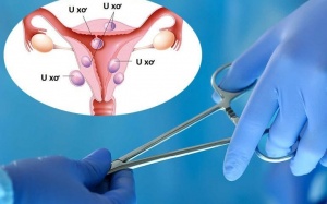 Bị u xơ tử cung khi nào cần mổ?