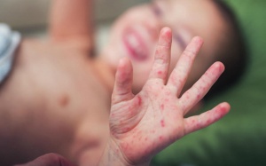 Nên cho trẻ ăn gì khi bị tay chân miệng?