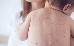 Những điều cần biết về bệnh thủy đậu ở trẻ nhỏ