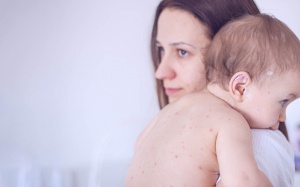 Những bệnh có thể khiến trẻ nổi mụn nước, bóng nước trên da