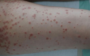 Cách kiểm soát bệnh vảy nến thể giọt an toàn, hiệu quả